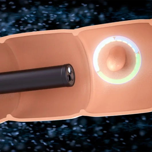 Colon Polyps Treatment Singapore