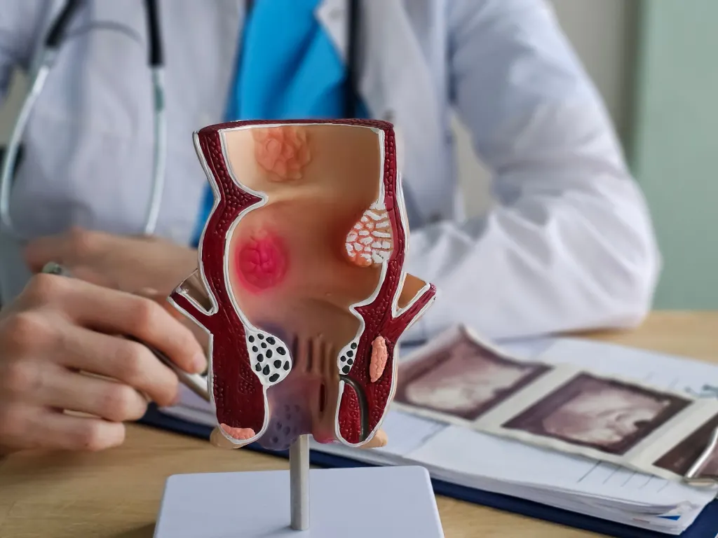 Anal Abscess Singapore