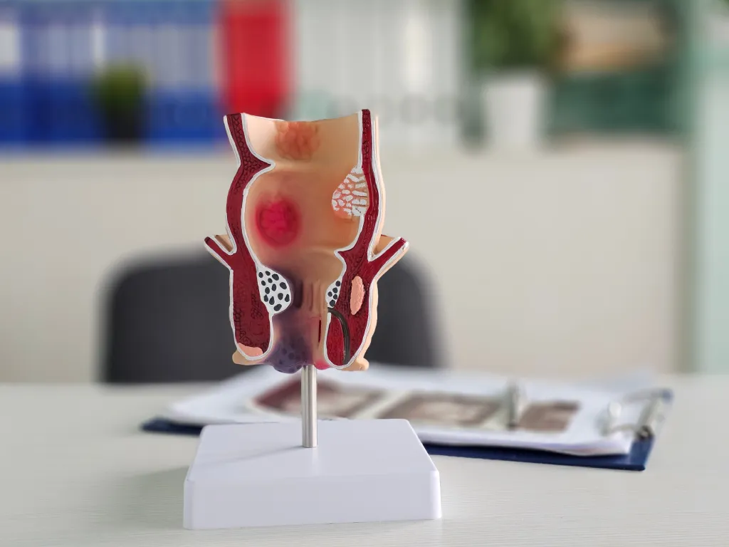 Anal Fistula Surgery Singapore