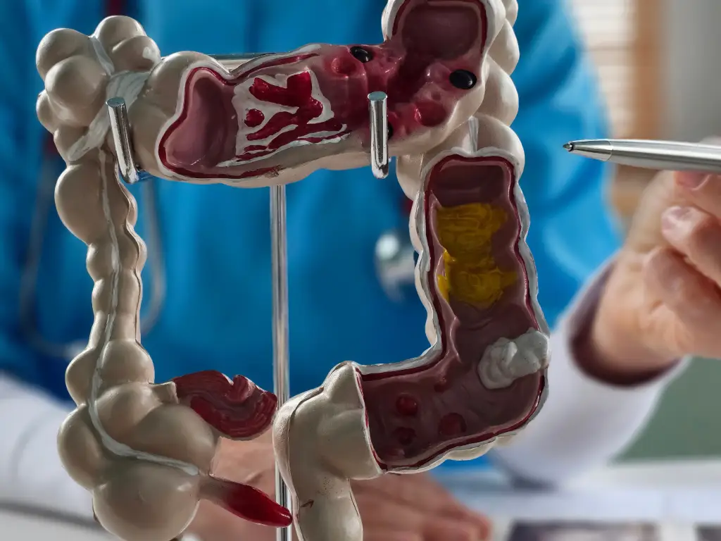 Diverticular Disease Treatment Singapore