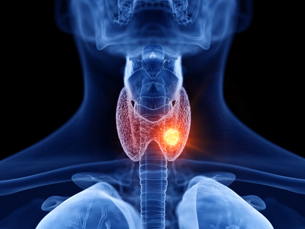 Thyroid cancer tumour in the neck