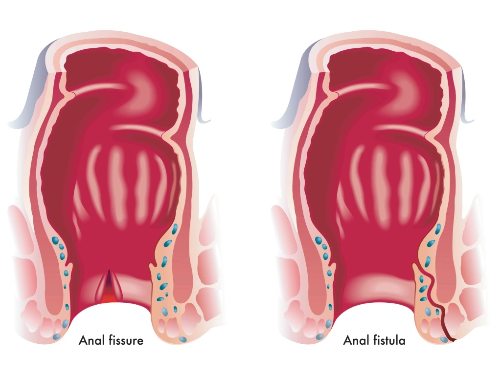 Illustration of an anal fistula
