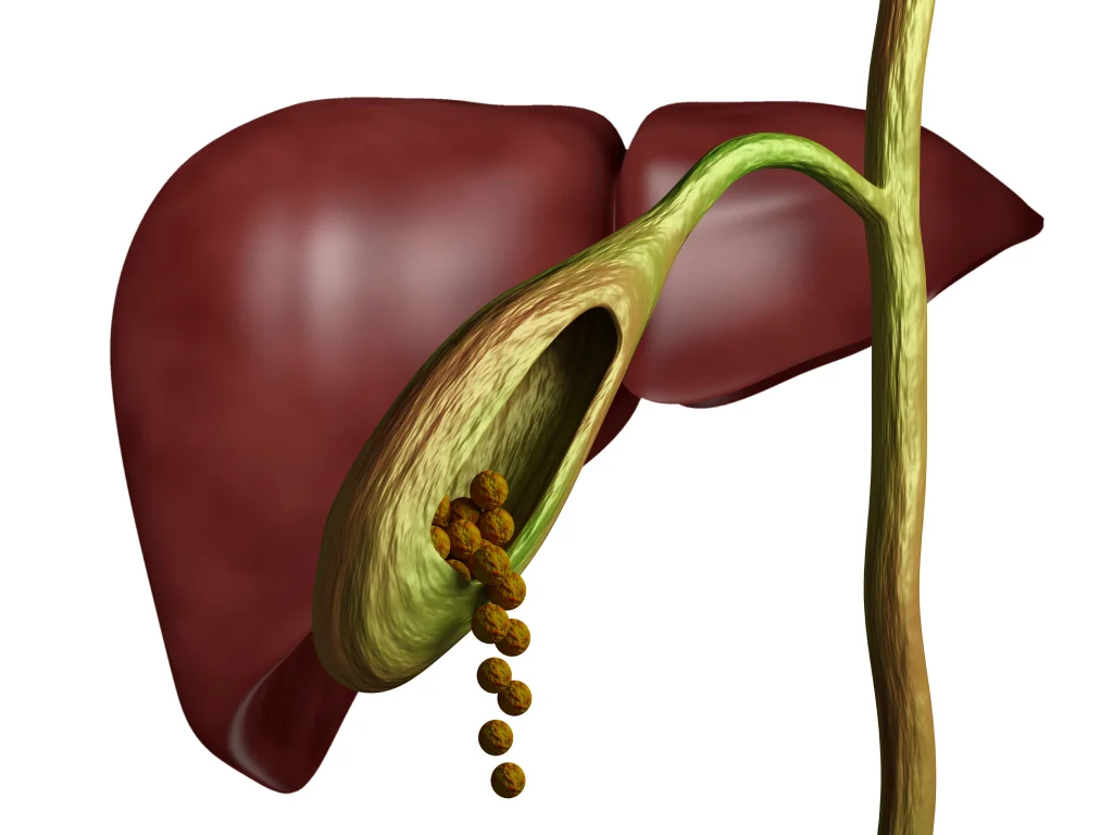 Gallbladder Stones Removal