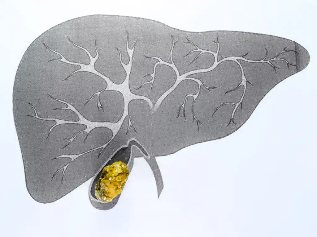 Gallstones Treatment Singapore